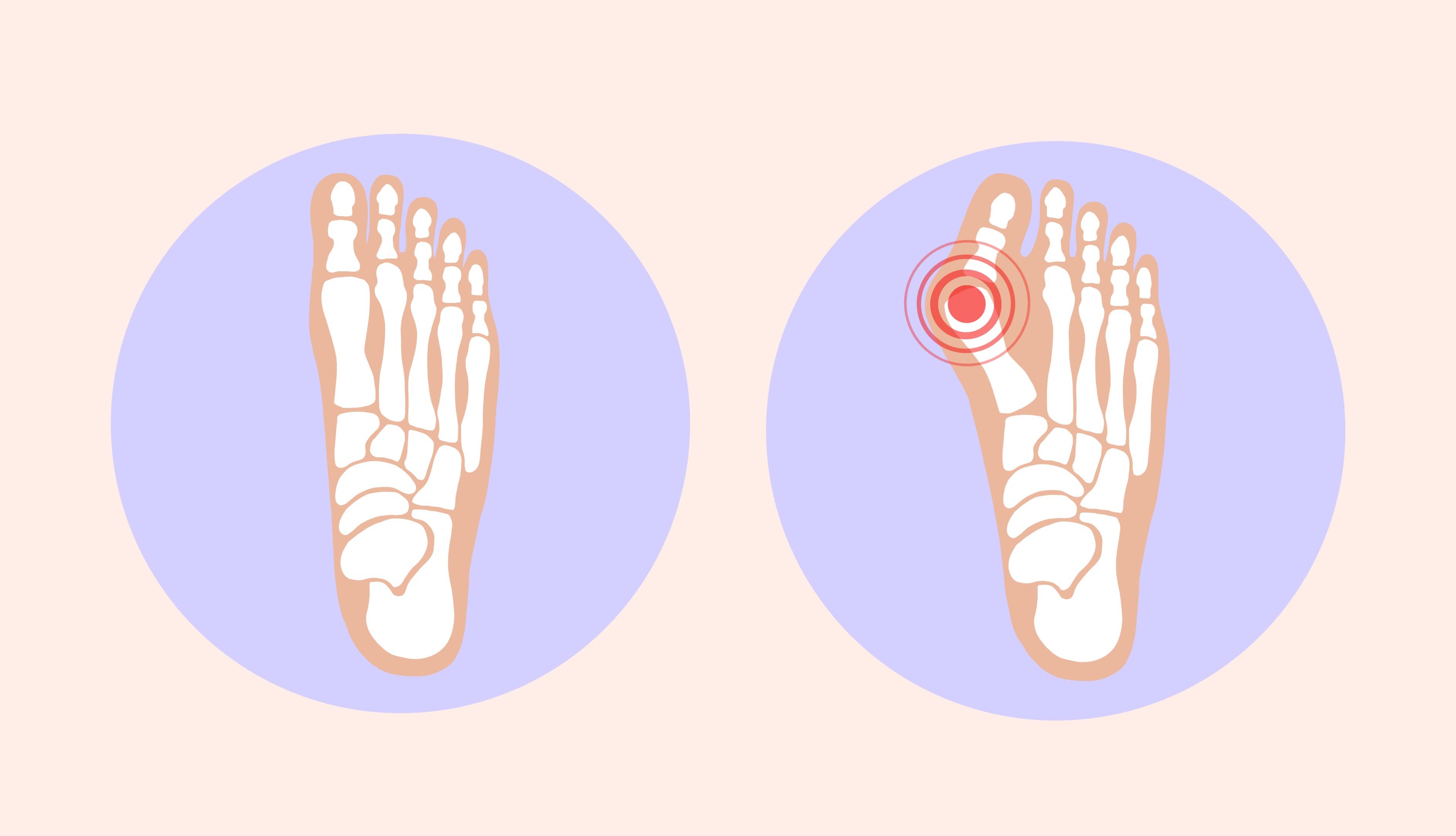 Qu’est-ce qu’un hallux valgus