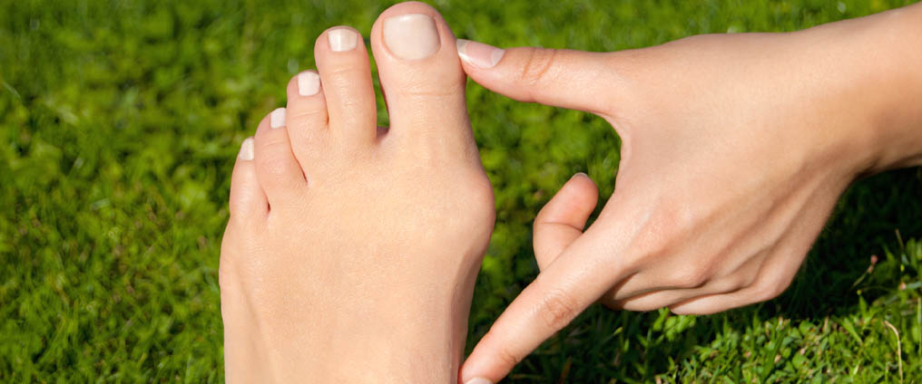 Hallux valgus (« oignon » au pied) : symptômes, causes et traitement