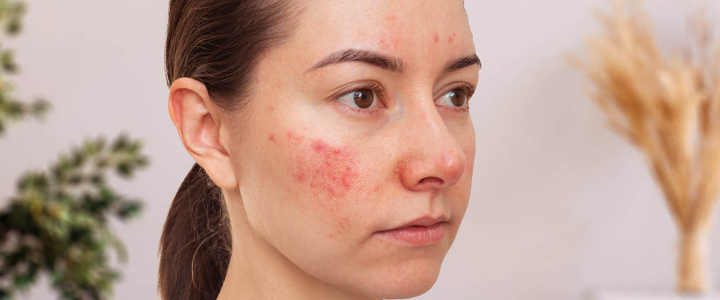 Le lupus érythémateux disséminé : causes, symptômes et traitement