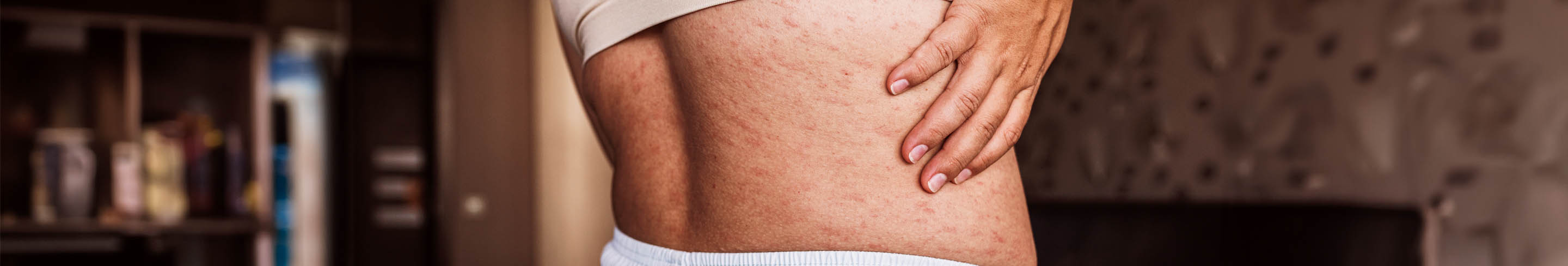 pityriasis versicolor