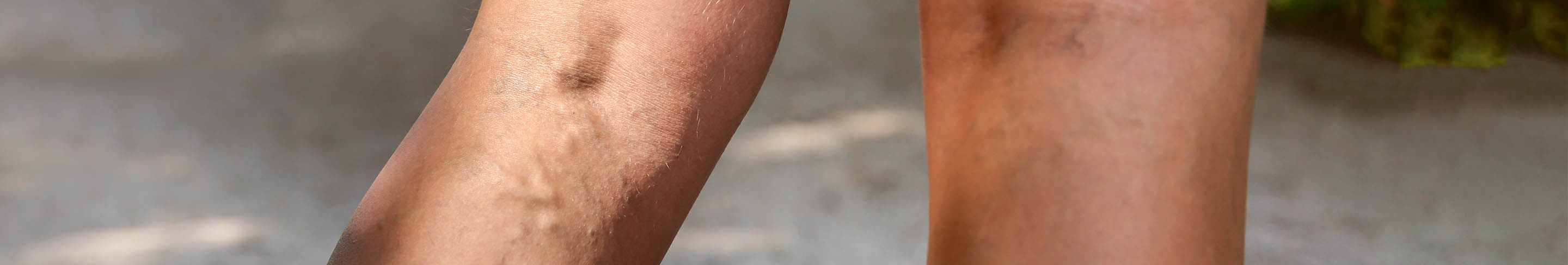 thrombophlebite header