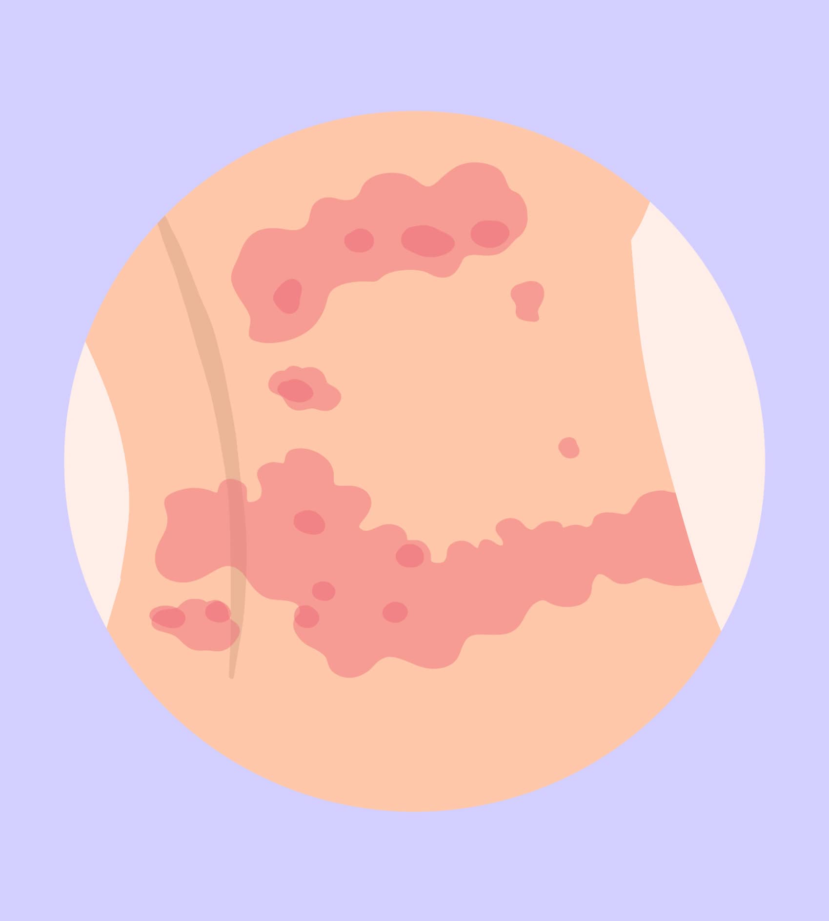urticaire papules