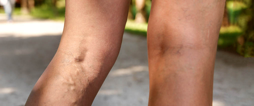 Varices - Symptômes, cause et traitement 